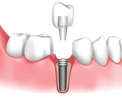 dental-implant