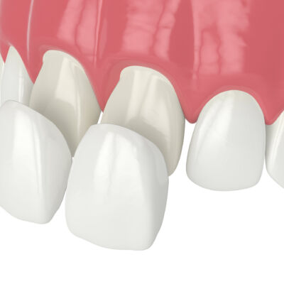 3d render of upper jaw with veneers over white