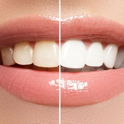 difference-between-teeth-cleaning-and-teeth-bleaching