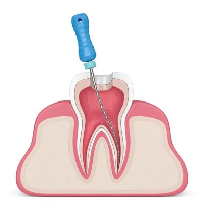 rootcanalfiling-min
